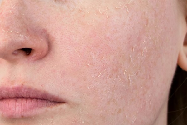 Tác hại của Retinol trên da nếu dùng sai liều lượng hoặc không đúng cách